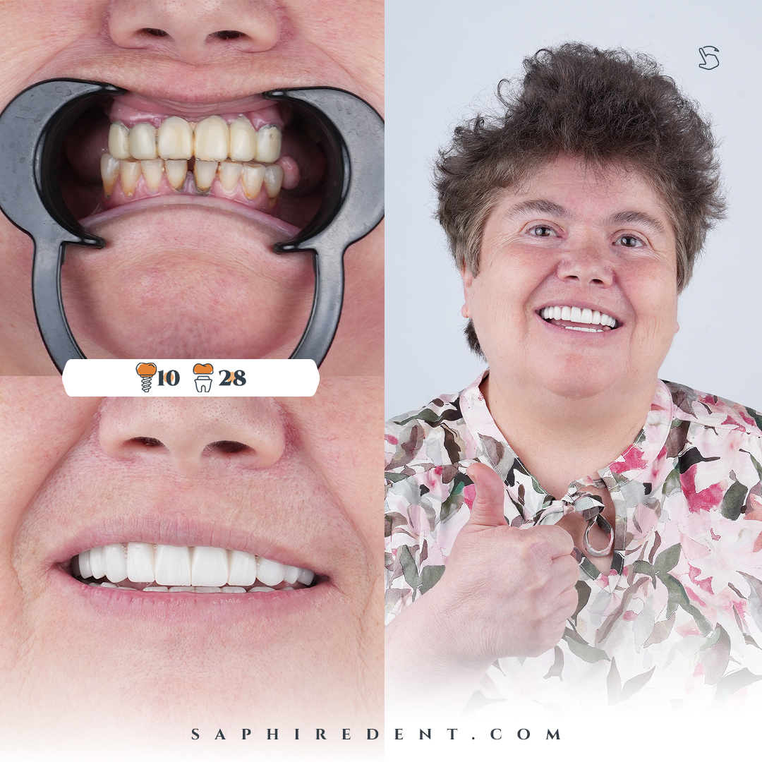 Hollywood Smile